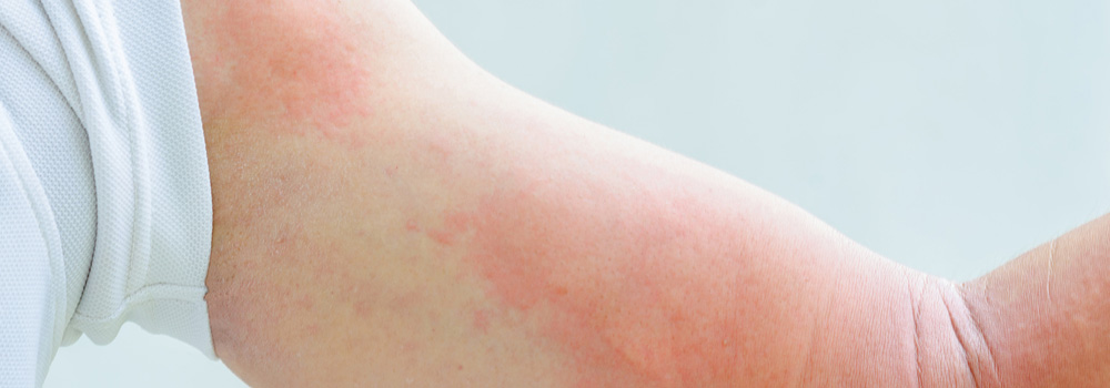 Urticaria or hives
